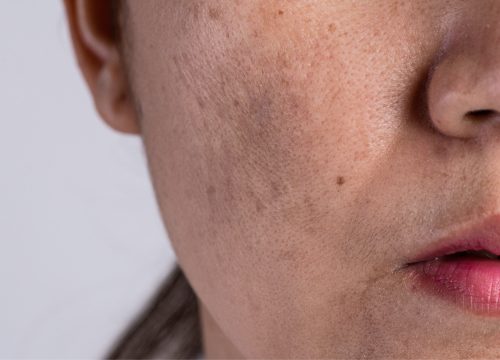 Melasma on woman's face