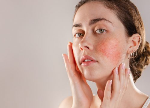 Woman with rosacea