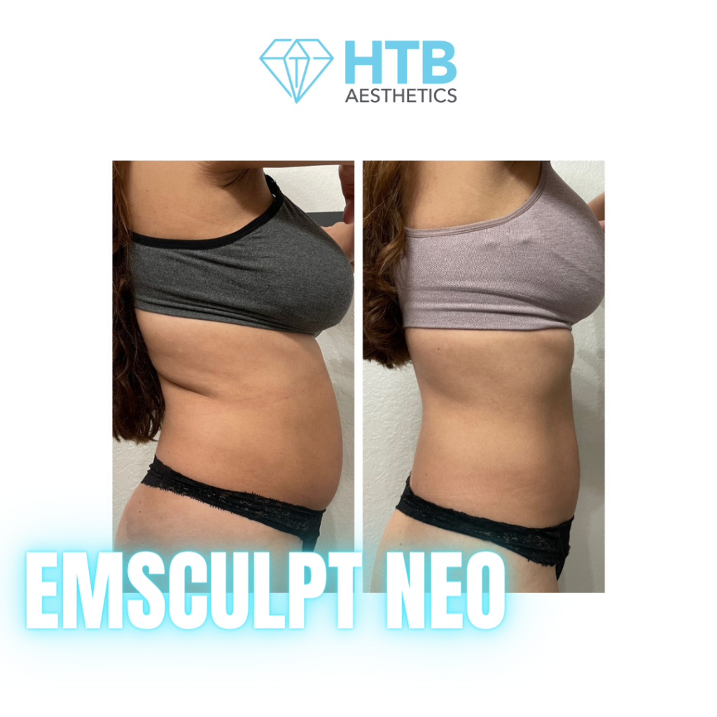 Before and after emsculpt neo results