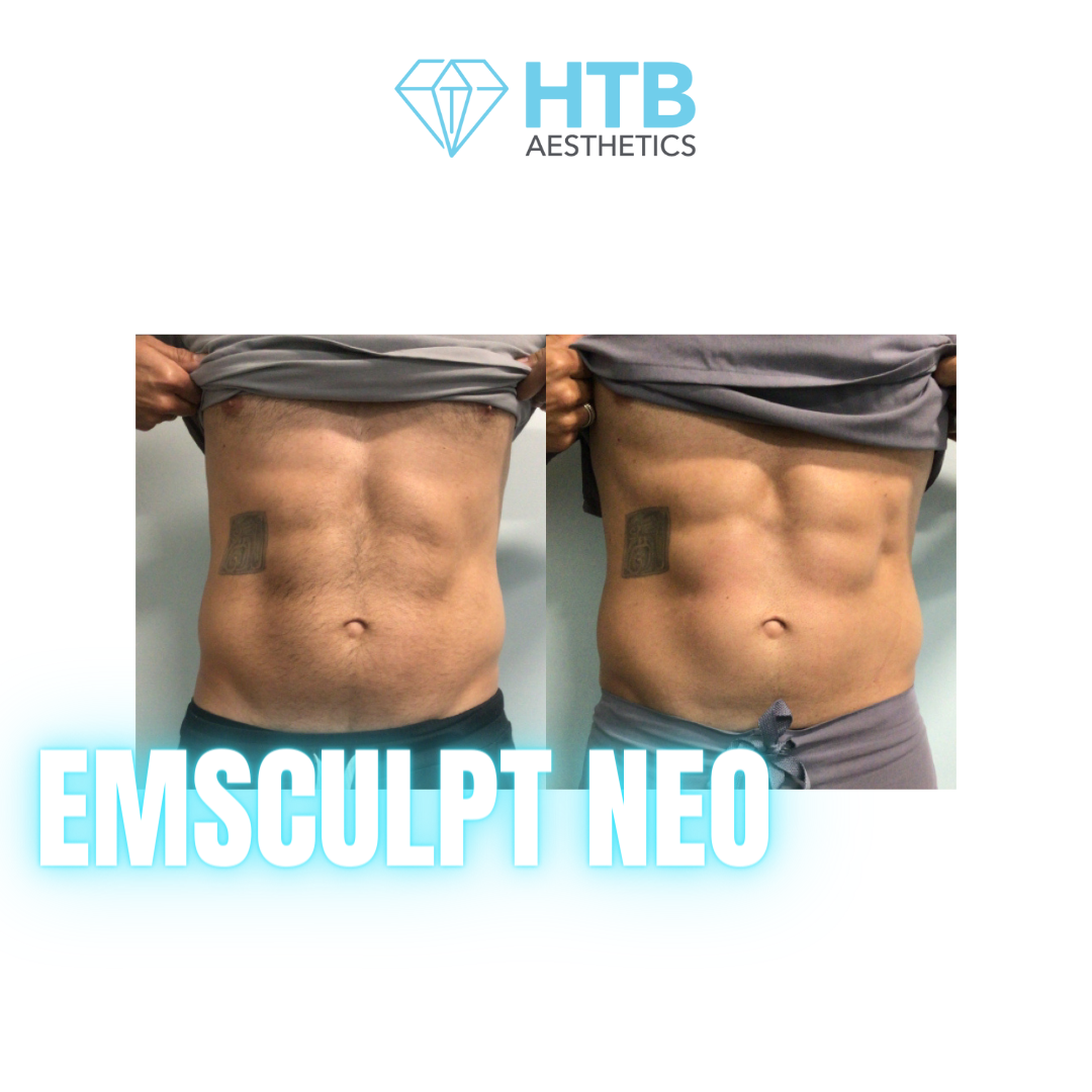 Body Contouring - Emsculpt NEO and Cellutone