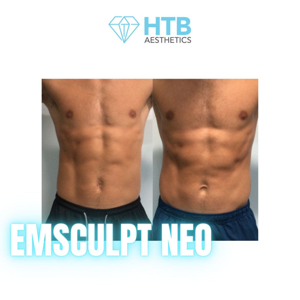 Before and after emsculpt neo results