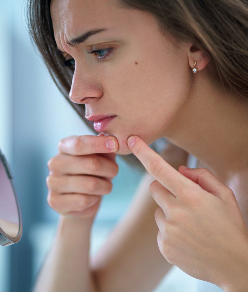 Woman squeezing a pimple on her chin