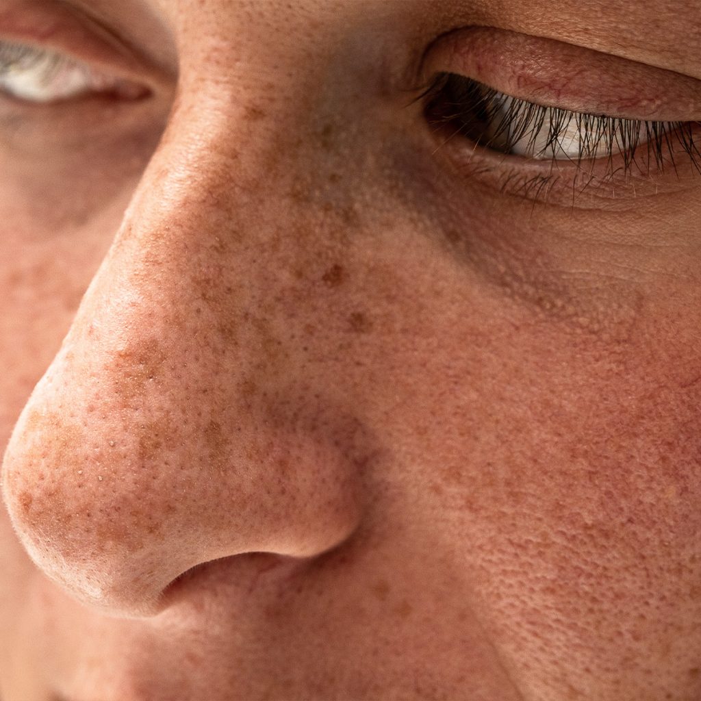 Sun damage on a person's face