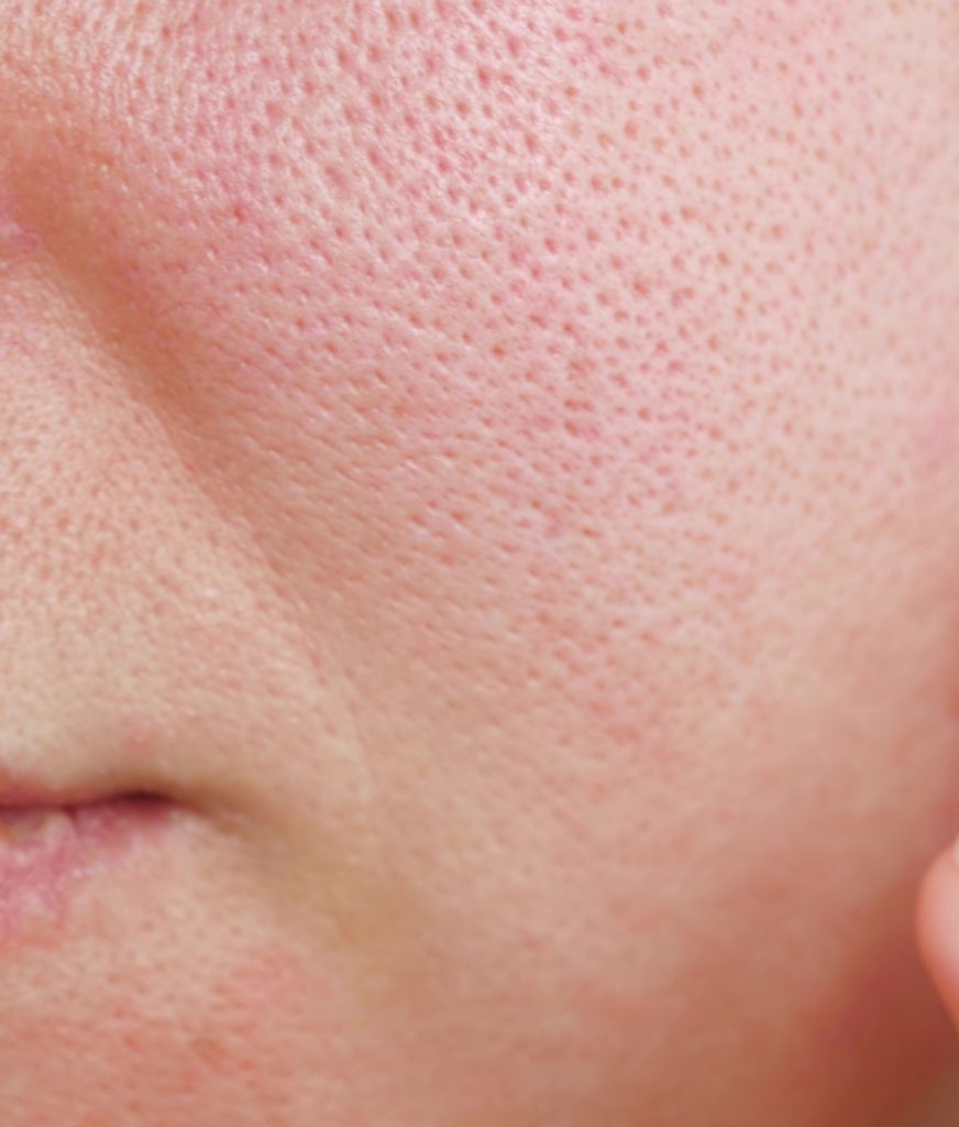 Large pores on a person's face